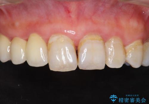 被せ物がかけた 綺麗で丈夫なセラミックのブリッジへ 60代女性の治療後