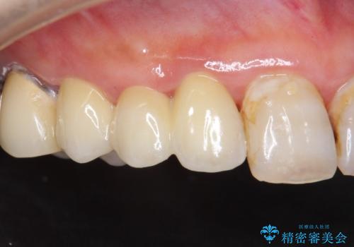 被せ物がかけた 綺麗で丈夫なセラミックのブリッジへ 60代女性の症例 治療後