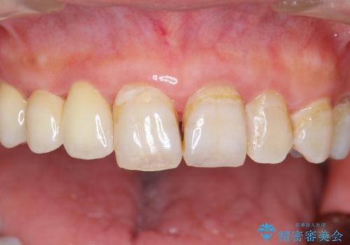 被せ物がかけた 綺麗で丈夫なセラミックのブリッジへ 60代女性の治療後