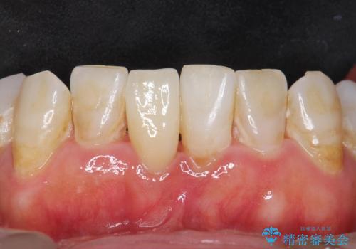 被せ物がかけた 綺麗で丈夫なセラミックのブリッジへ 60代女性の治療後
