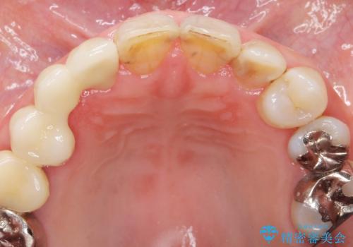 被せ物がかけた 綺麗で丈夫なセラミックのブリッジへ 60代女性の治療後