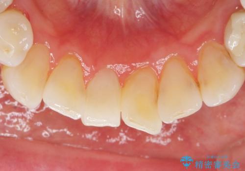 被せ物がかけた 綺麗で丈夫なセラミックのブリッジへ 60代女性の治療後
