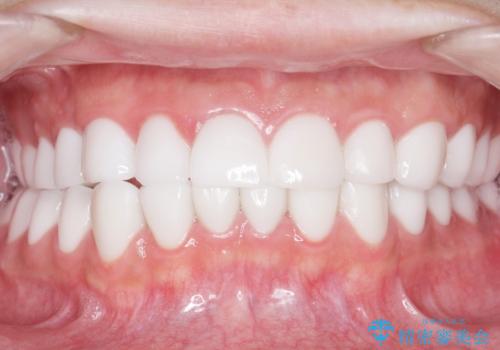 憧れの芸能人のような白い歯に 30代男性の治療後