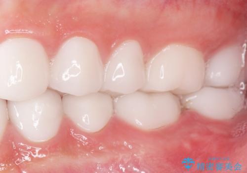 憧れの芸能人のような白い歯に 30代男性の治療後