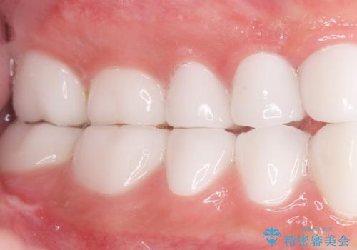 憧れの芸能人のような白い歯に 30代男性の治療後