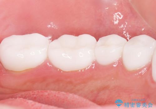 憧れの芸能人のような白い歯に 30代男性の治療後