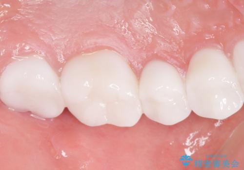 憧れの芸能人のような白い歯に 30代男性の治療後