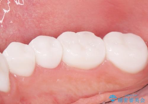 憧れの芸能人のような白い歯に 30代男性の治療後