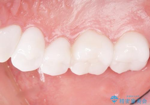 憧れの芸能人のような白い歯に 30代男性の治療後