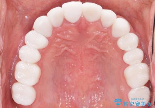 憧れの芸能人のような白い歯に 30代男性の治療後