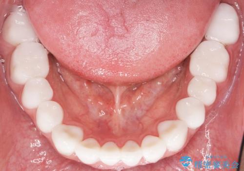 憧れの芸能人のような白い歯に 30代男性の治療後