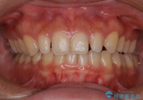 前歯のセラミック製作前にPMTCの治療前