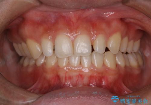 前歯のセラミック製作前にPMTCの治療後