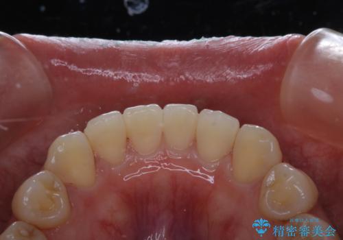 前歯のセラミック製作前にPMTCの治療後