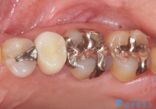 歯ぐきを押すと痛い 神経が死んでいる歯の治療 40代女性の治療後