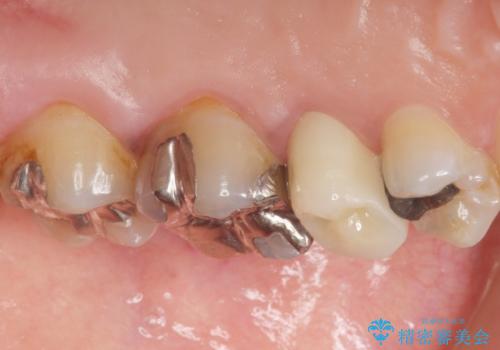 歯ぐきを押すと痛い 神経が死んでいる歯の治療 40代女性の治療後