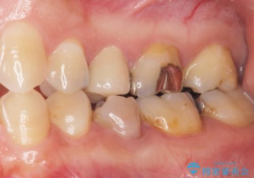 歯ぐきを押すと痛い 神経が死んでいる歯の治療 40代女性の症例 治療後