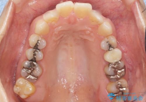 歯ぐきを押すと痛い 神経が死んでいる歯の治療 40代女性の治療後