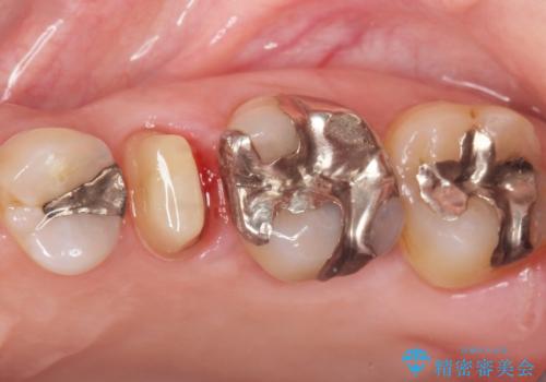 歯ぐきを押すと痛い　神経が死んでいる歯の治療　40代女性の治療中