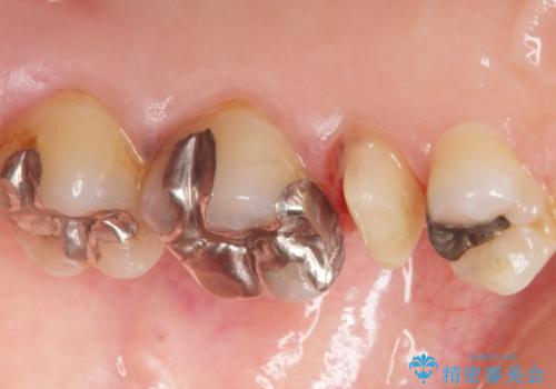 歯ぐきを押すと痛い 神経が死んでいる歯の治療 40代女性の治療中