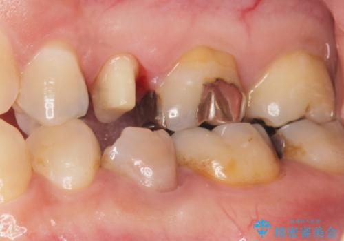 歯ぐきを押すと痛い 神経が死んでいる歯の治療 40代女性の治療中