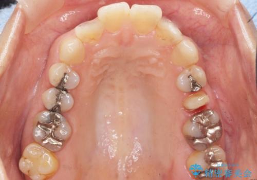 歯ぐきを押すと痛い 神経が死んでいる歯の治療 40代女性の治療中