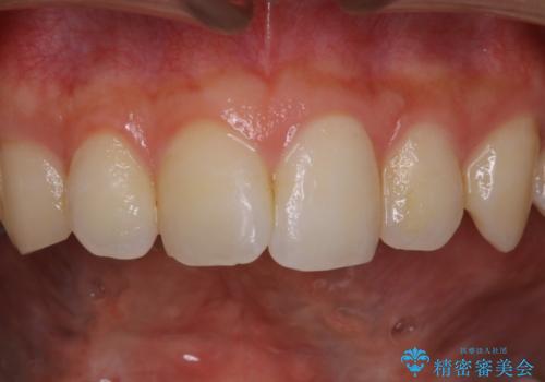 30代男性　虫歯の治療前にPMTCの症例 治療前