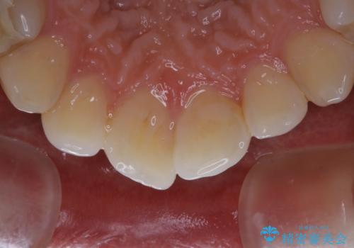 30代男性 虫歯の治療前にPMTCの治療前