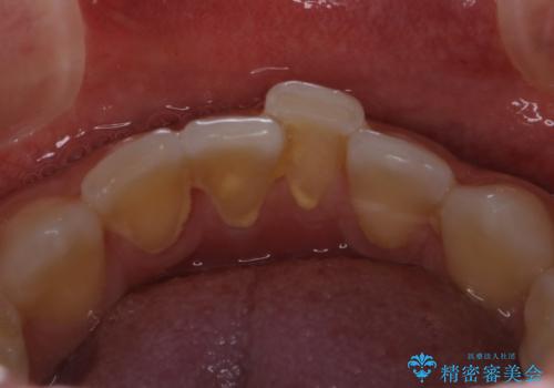 30代男性 虫歯の治療前にPMTCの治療前