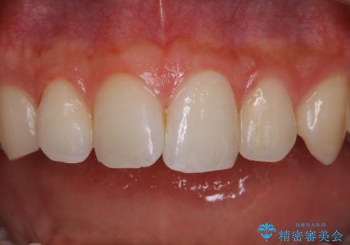 30代男性　虫歯の治療前にPMTCの症例 治療後