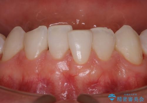 30代男性 虫歯の治療前にPMTCの治療後