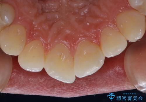 30代男性 虫歯の治療前にPMTCの治療後