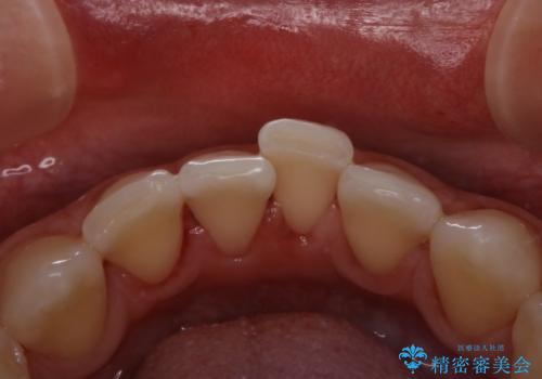 30代男性　虫歯の治療前にPMTCの治療後
