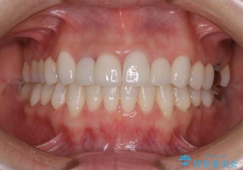 デンタルフロスが通せない PMTCでしっかり通るようにの治療前