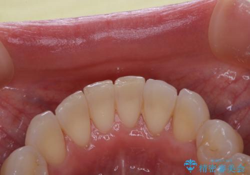 デンタルフロスが通せない PMTCでしっかり通るようにの治療前