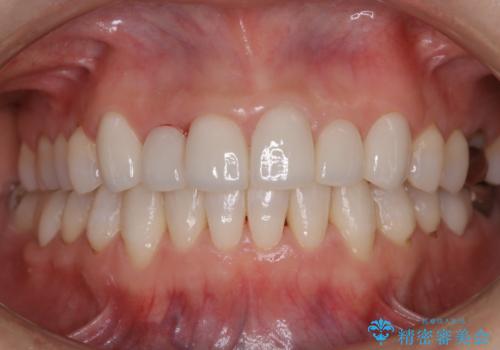 デンタルフロスが通せない PMTCでしっかり通るようにの治療後