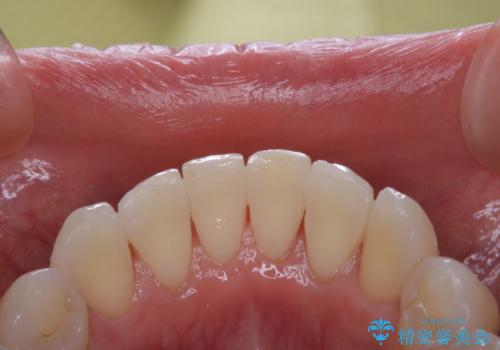 デンタルフロスが通せない PMTCでしっかり通るようにの治療後