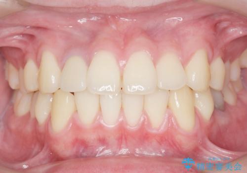 他院で入れたセラミッククラウンの色が気に入らない 20代男性の治療後