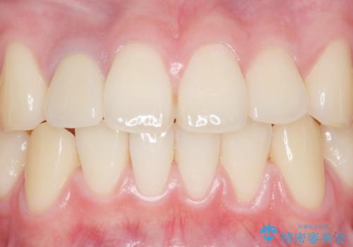 他院で入れたセラミッククラウンの色が気に入らない 20代男性の治療後