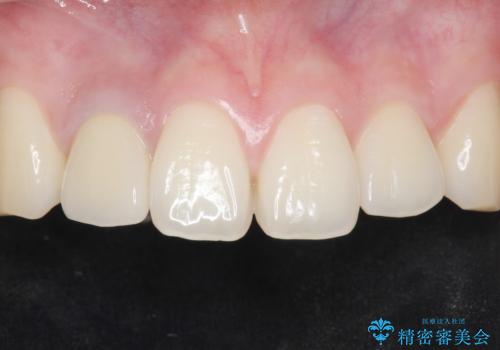 他院で入れたセラミッククラウンの色が気に入らない 20代男性の症例 治療後