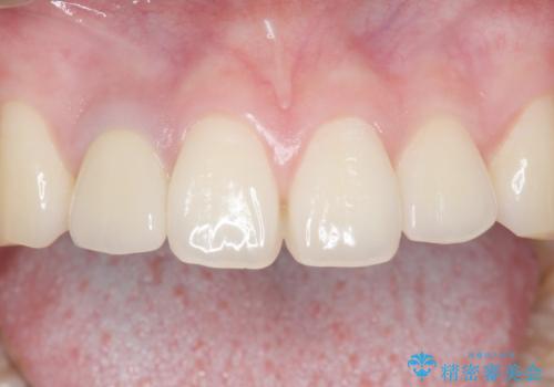 他院で入れたセラミッククラウンの色が気に入らない 20代男性の治療後
