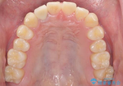 他院で入れたセラミッククラウンの色が気に入らない 20代男性の治療後