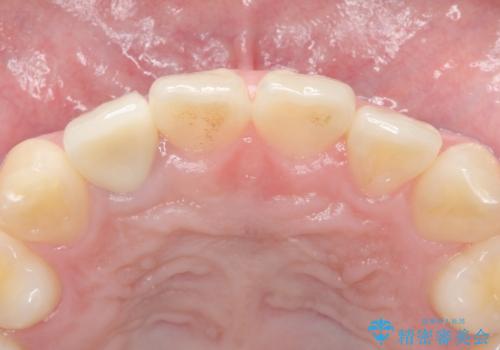 他院で入れたセラミッククラウンの色が気に入らない 20代男性の治療後