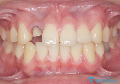 他院で入れたセラミッククラウンの色が気に入らない 20代男性の治療中