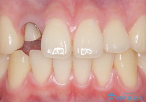 他院で入れたセラミッククラウンの色が気に入らない 20代男性の治療中