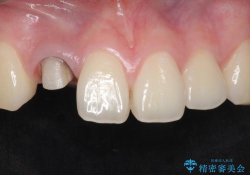 他院で入れたセラミッククラウンの色が気に入らない 20代男性の治療中