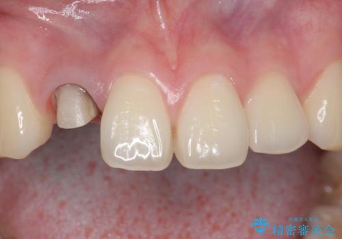 他院で入れたセラミッククラウンの色が気に入らない 20代男性の治療中