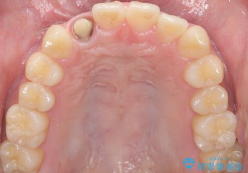 他院で入れたセラミッククラウンの色が気に入らない 20代男性の治療中