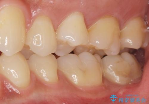 奥歯にフロスを通すと臭い 30代女性の治療前