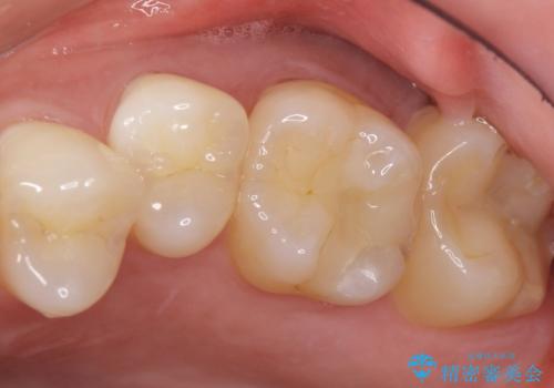 奥歯にフロスを通すと臭い 30代女性の治療前